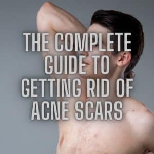 acne scars